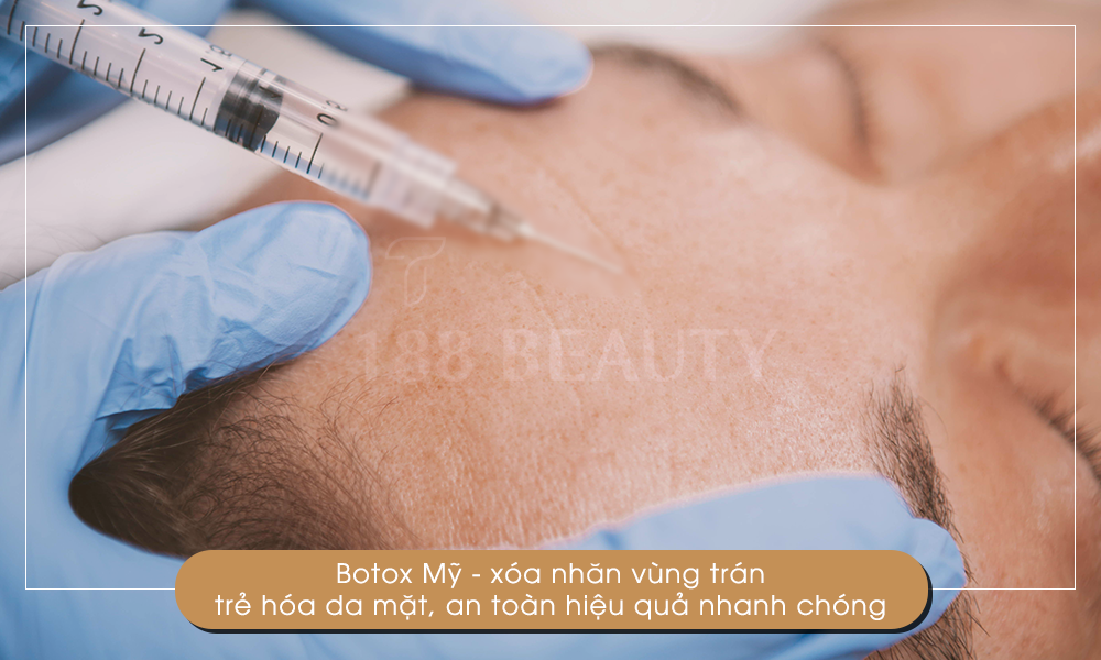 14-Botox-Mỹ-xóa-nhăn-trán