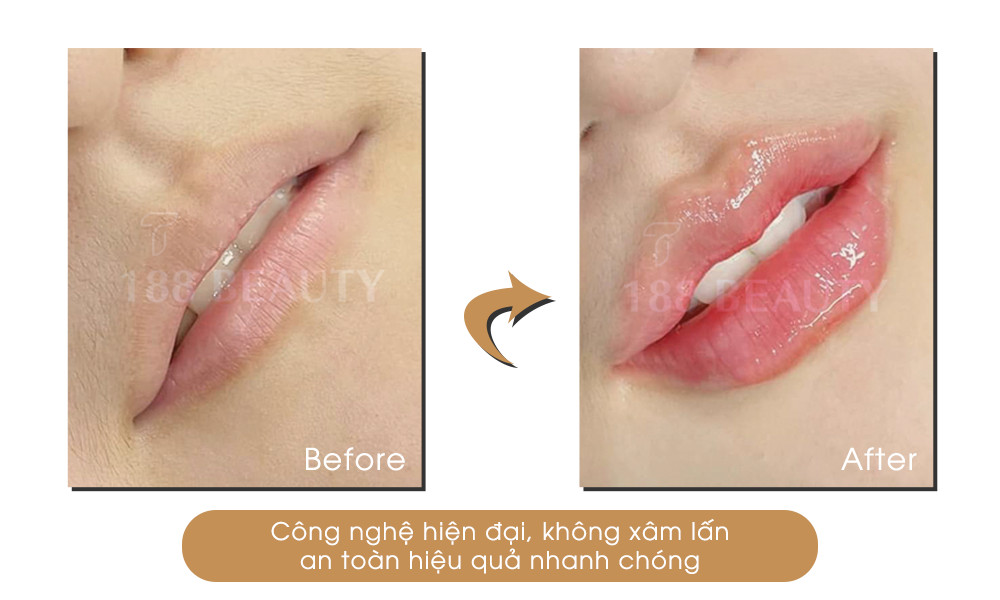 DỊCH VỤ FILLER(1)
