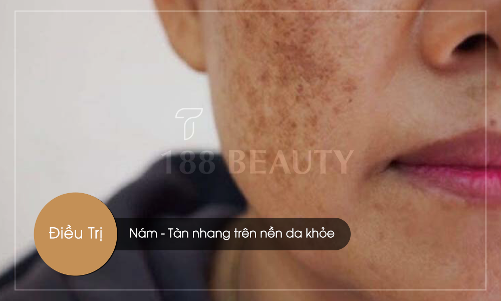 Nám-tàn-nhang-da-khỏe