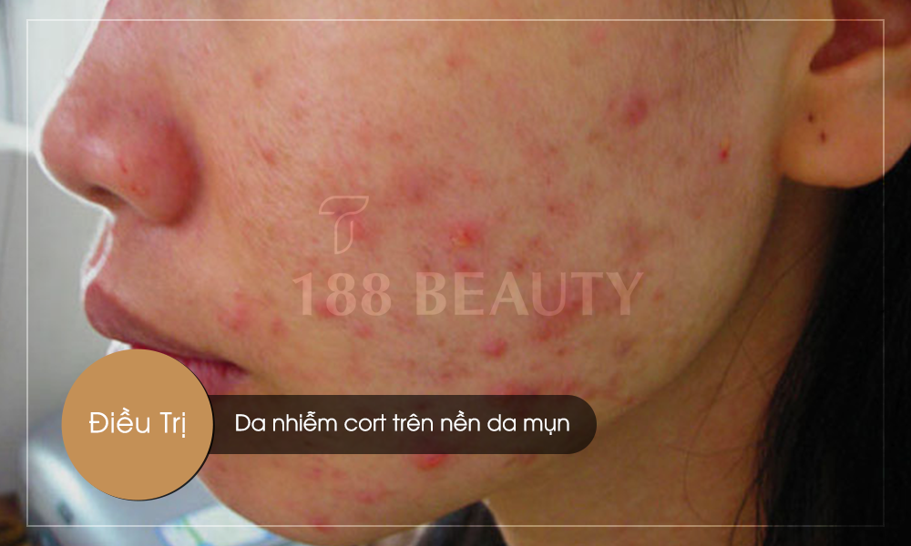 Nhiễm-cort-da-mụn