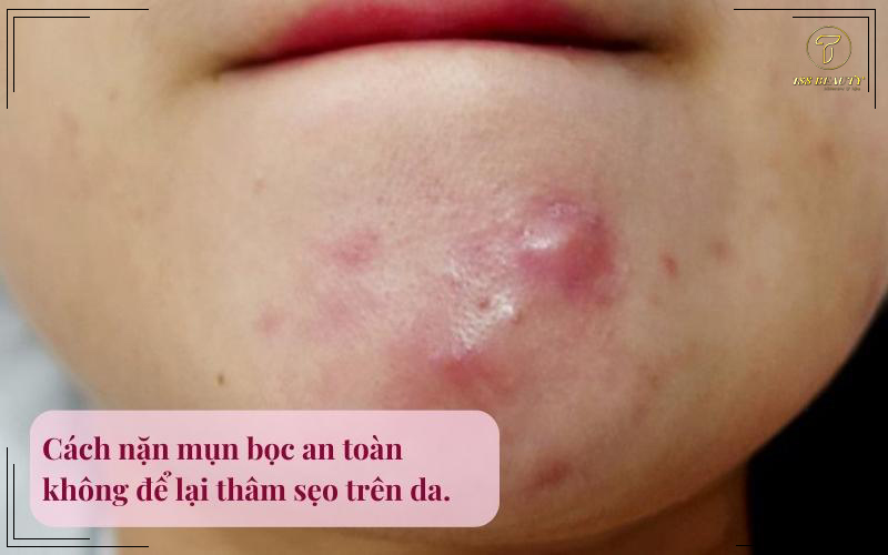 Cách nặn mụn bọc