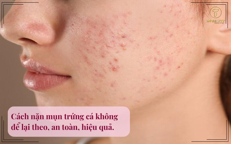 Cách nặn mụn trứng cá