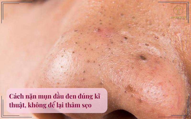 Cách nặn mụn đầu đen