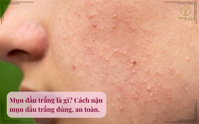 Mụn đầu trắng