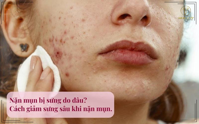 Nặn mụn bị sưng