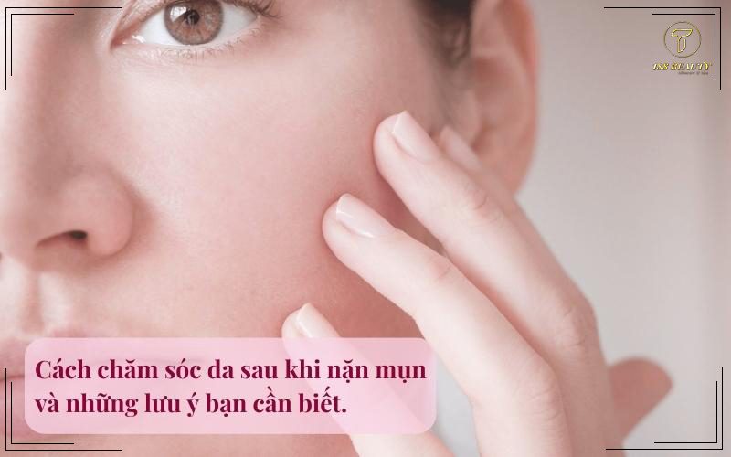 Nặn mụn xong nên làm gì?