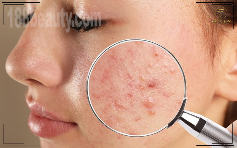 Teenage,Girl,With,Acne,Problem,Visiting,Dermatologist,,Closeup.,Skin,Under